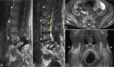 Infiltration of the spinal cord and peripheral nerves in multiple myeloma